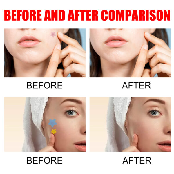 Pimple Patches,Pimple Patches For Face, Hydrocolloid Acne Patches, Cute Star Stickers Hydrocolloid Acne Pimple Patch For Covering Zits And Blemishes - Image 10